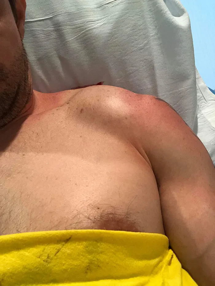 Miles' severe shoulder injury.